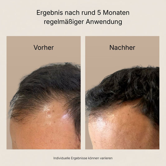 Vorher-Nachher-Ergebnis nach der Growly Haar-Kur – sichtbar dichterer Haaransatz
